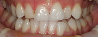 Izbjeljivanje zubi - poslije